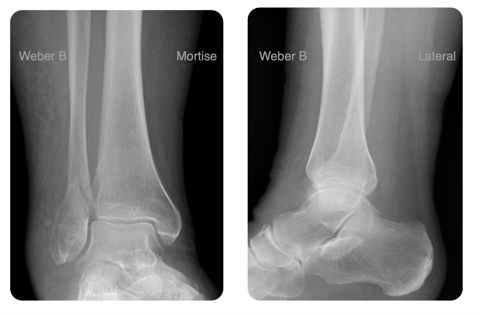 Ankle Fractures – OrthoSHO