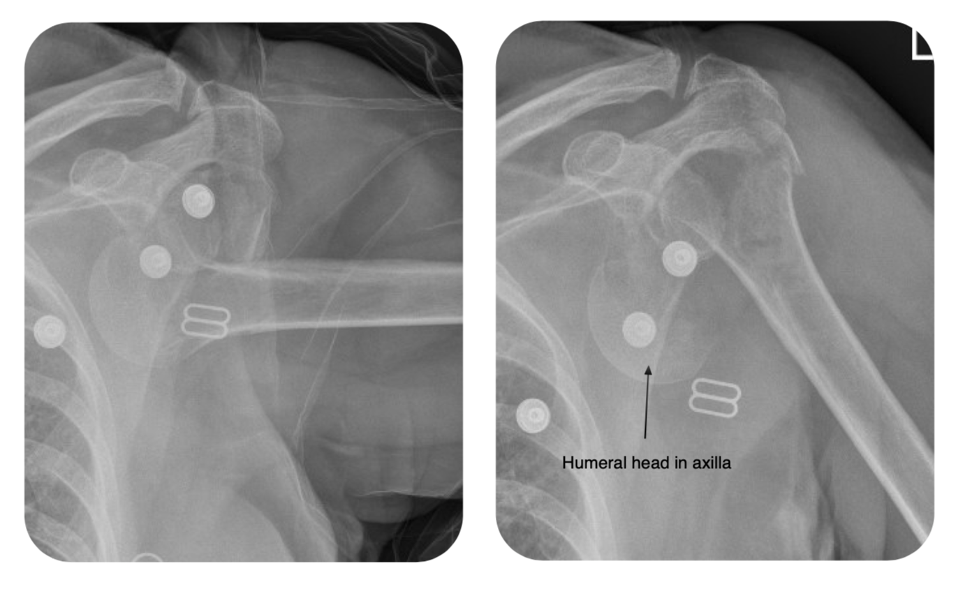 Shoulder Dislocation Orthosho