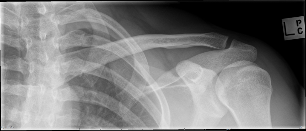 clavicle bone x ray