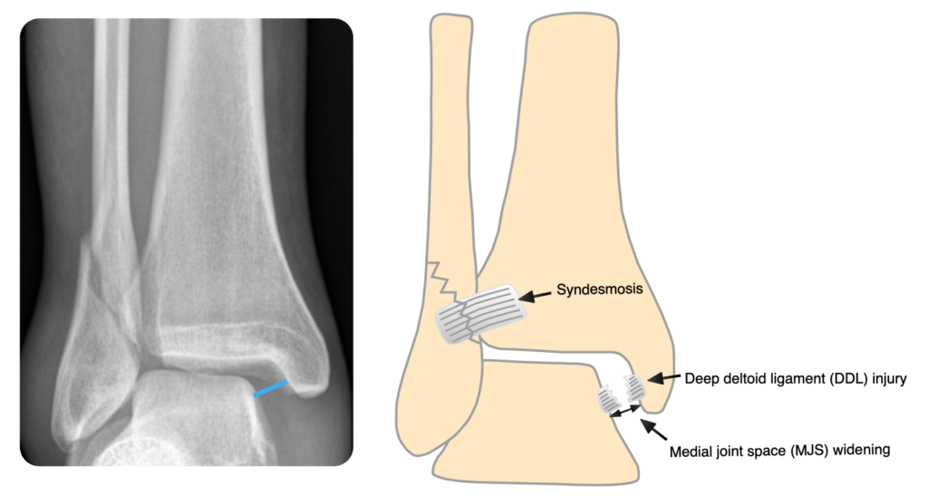 Ankle Fractures – OrthoSHO