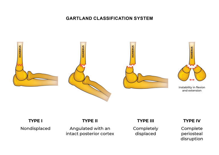 Supracondylar Humerus Fractures Orthosho