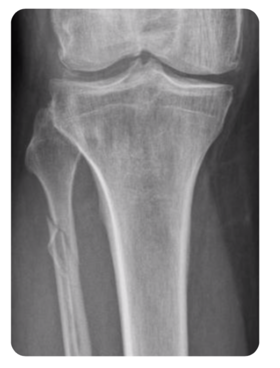 About Ankle Fractures