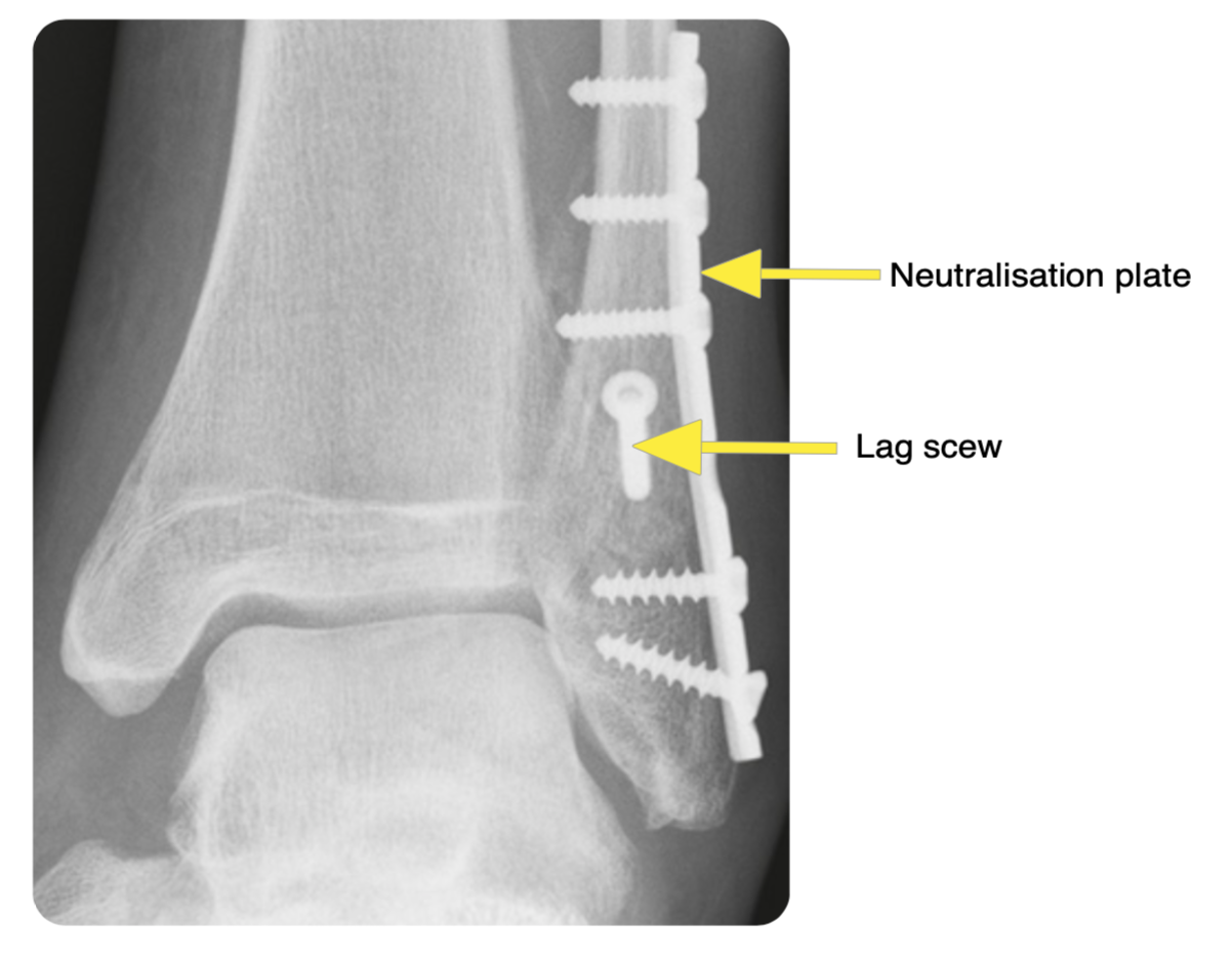 Ankle Fractures OrthoSHO Ankle Fractures OrthoSHO
