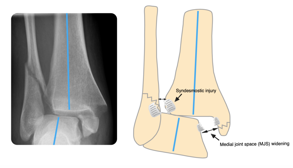 Trimalleolar fracture - Wikipedia