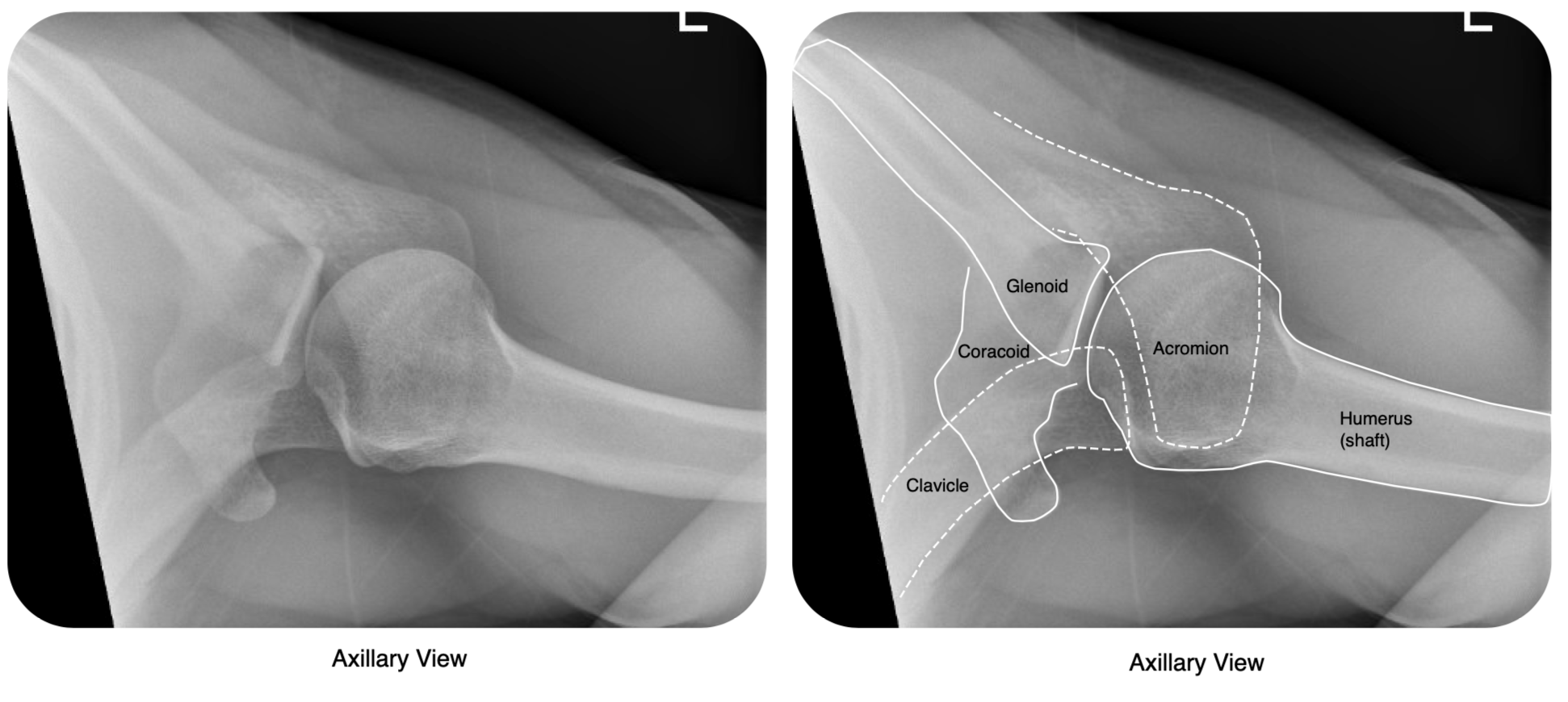 Shoulder Dislocation OrthoSHO