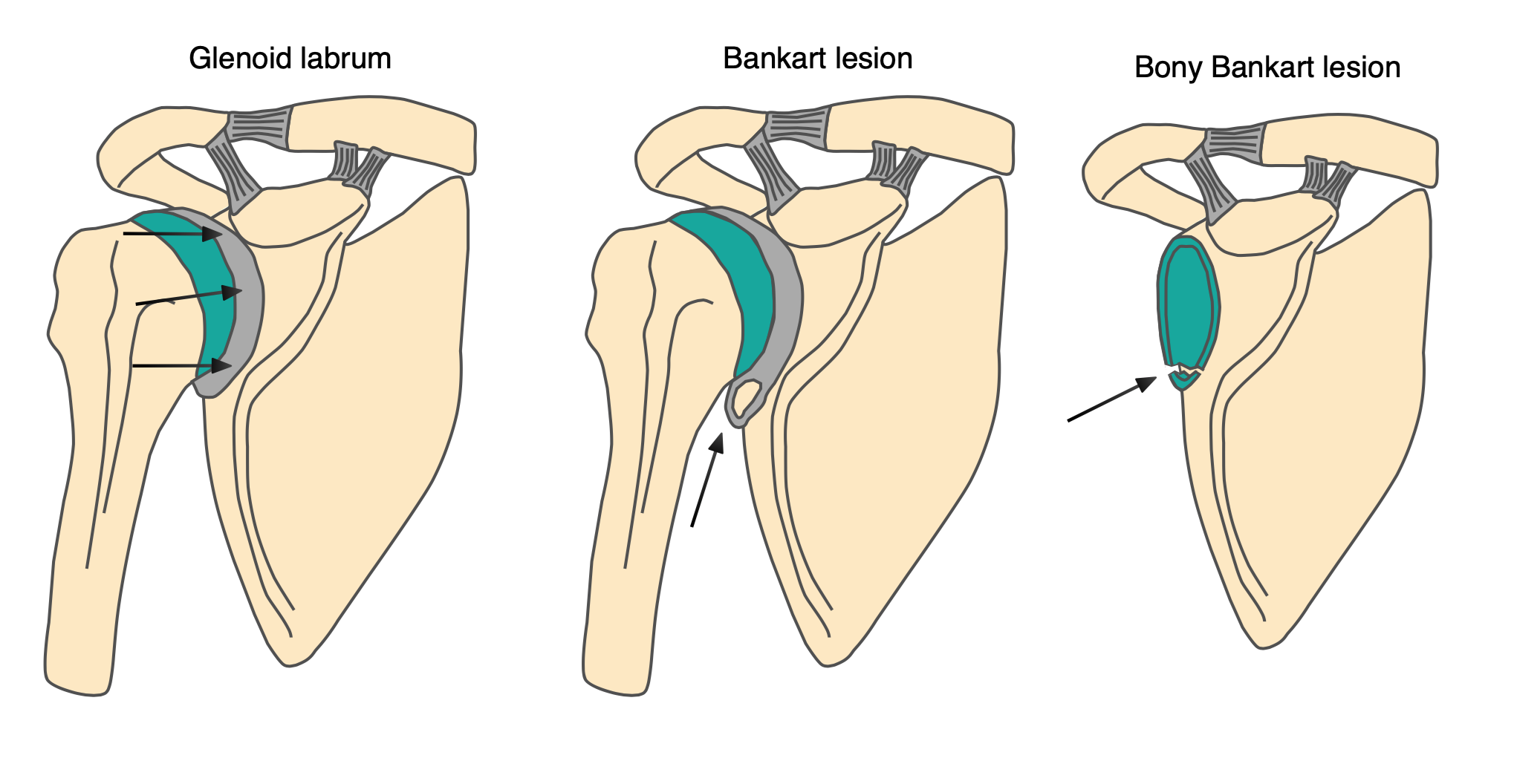 Can Bankart Fracture Cause Shoulder Dislocation BJVTIE Can Bankart Fracture Cause Shoulder Dislocation BJVTIE