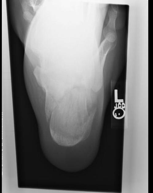 Tongue-Type Calcaneal Fracture due to a Low-Energy Injury