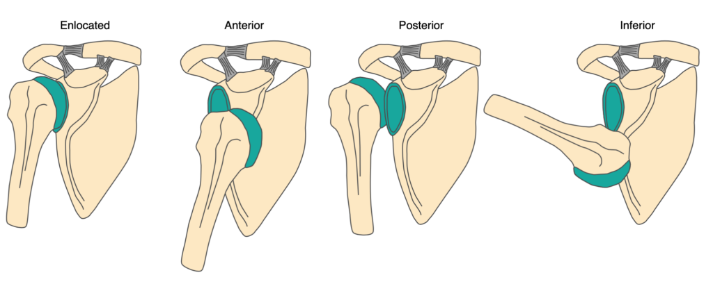 anterior shoulder dislocation